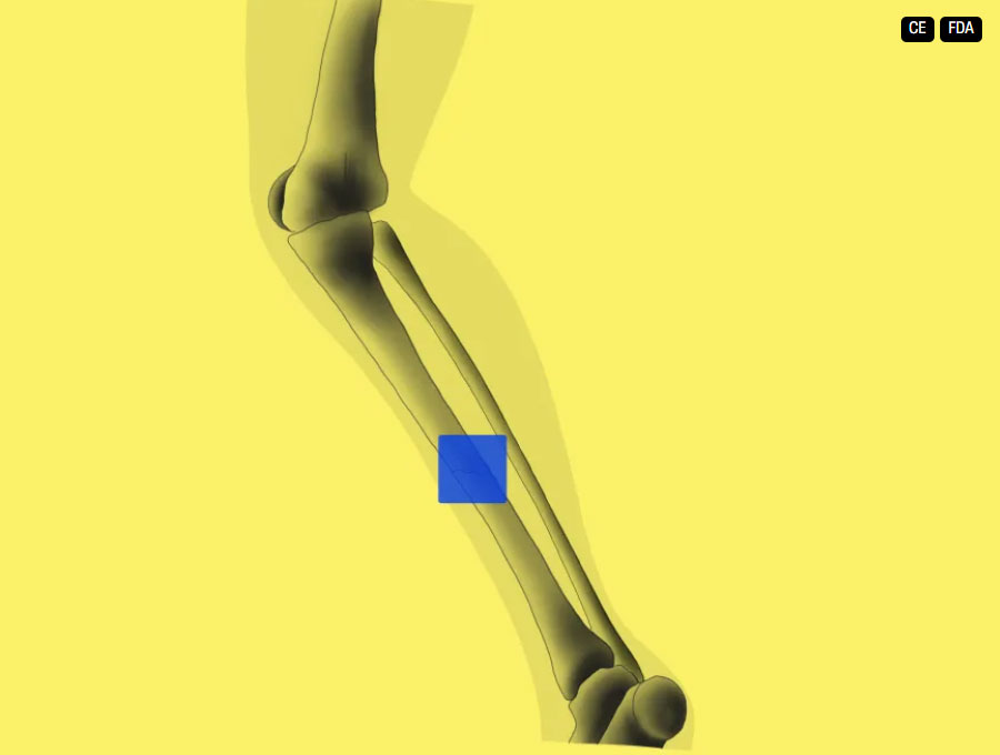 Gleamer BoneView