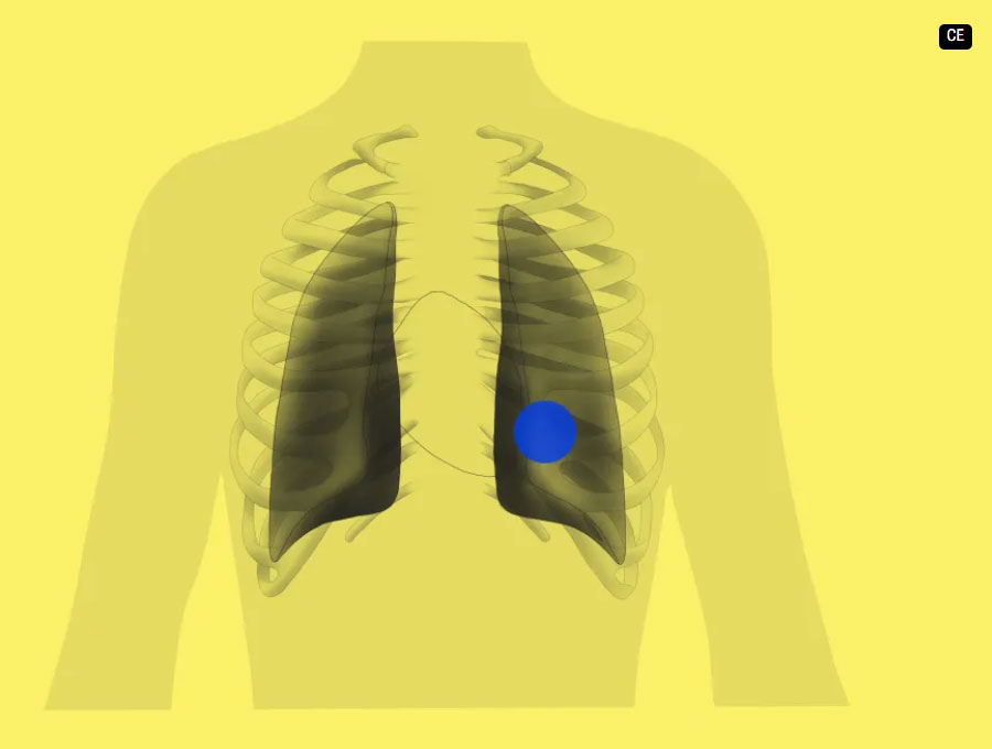 Gleamer ChestView